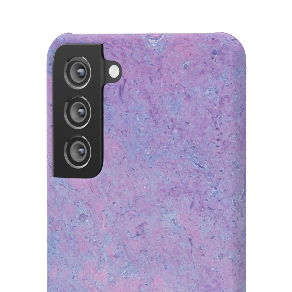 Slim Case Arterielles Myxom