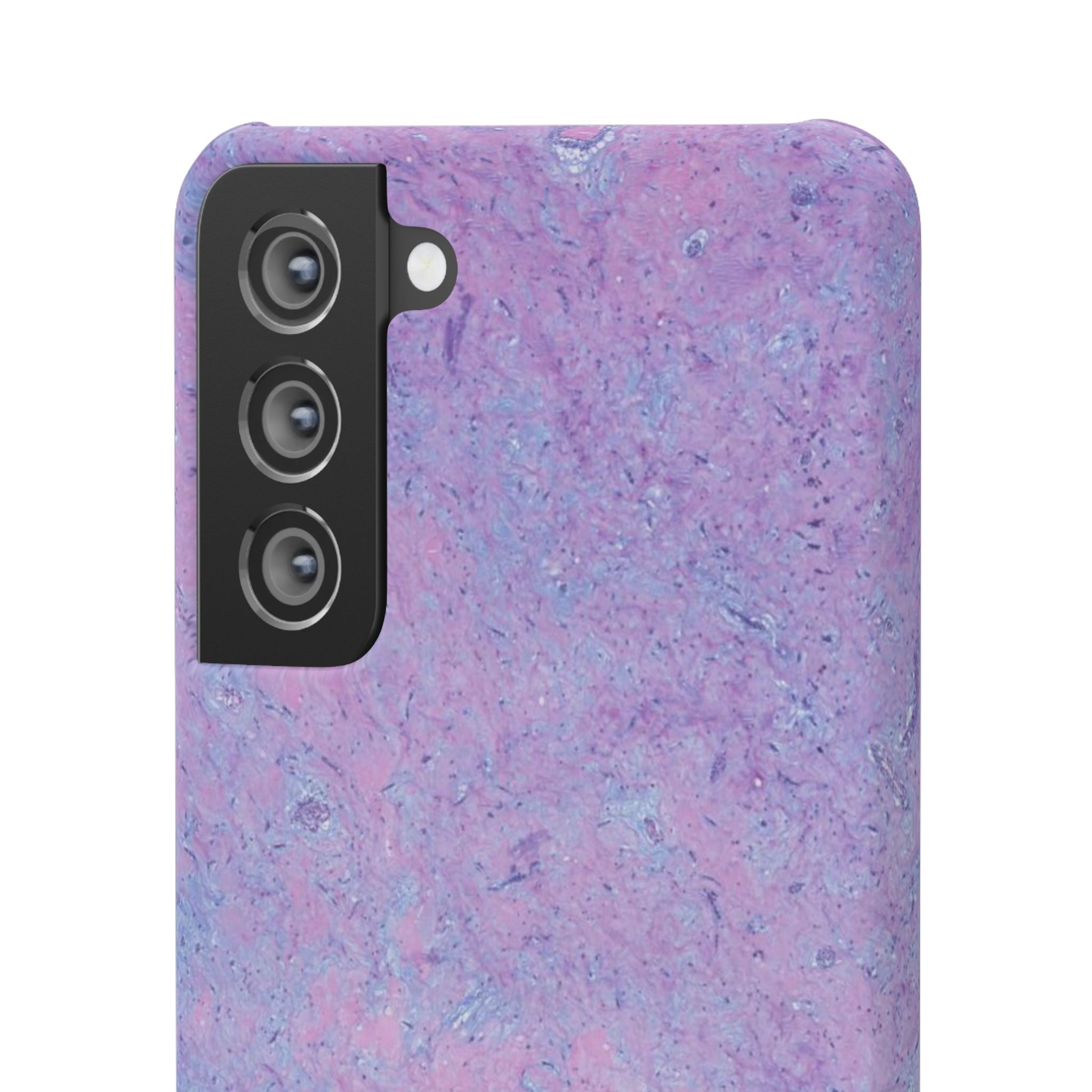 Slim Case Arterielles Myxom