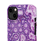 Slim Case Peutz-Jeghers Polyp