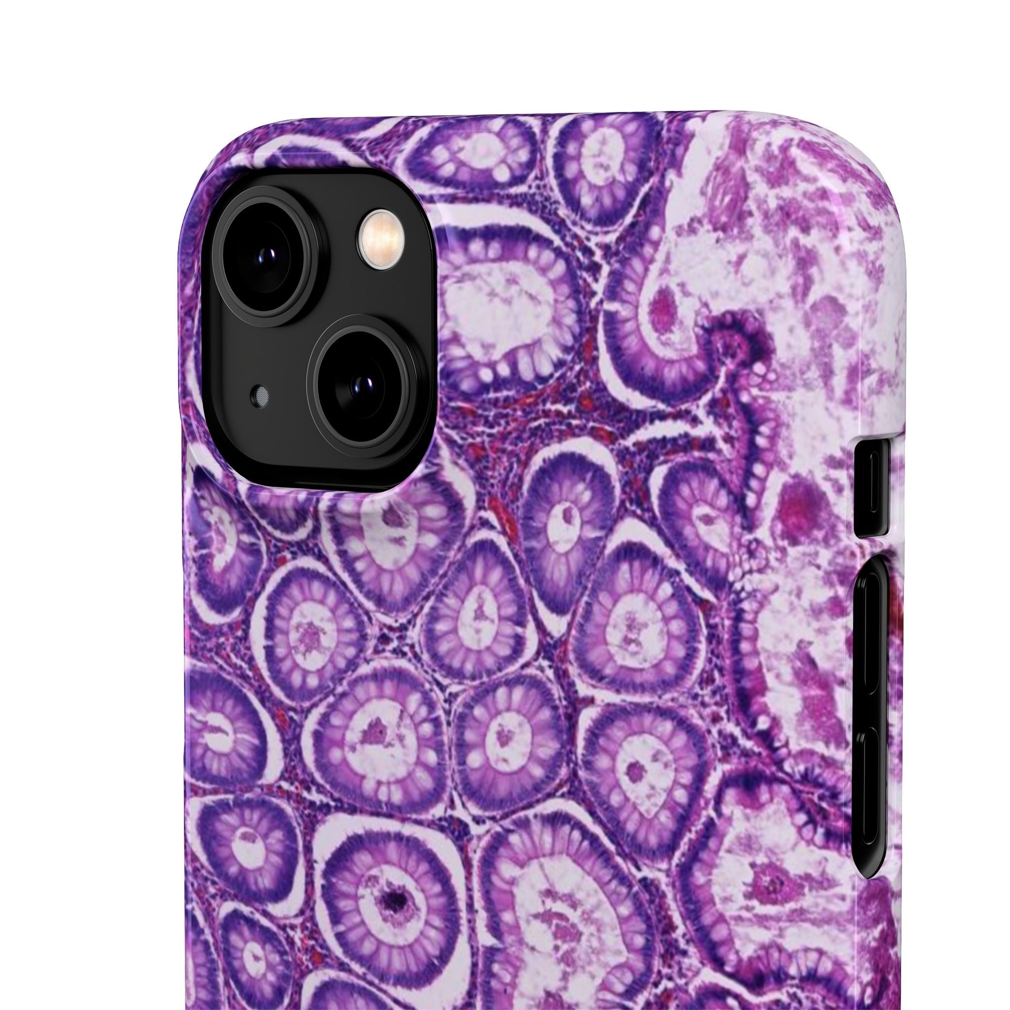 Slim Case Peutz-Jeghers Polyp