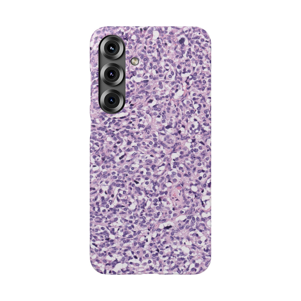 Slim Case Paraganglion
