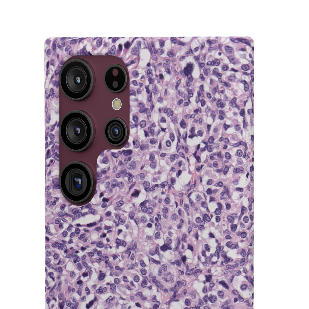 Slim Case Paraganglion