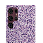 Slim Case Paraganglion