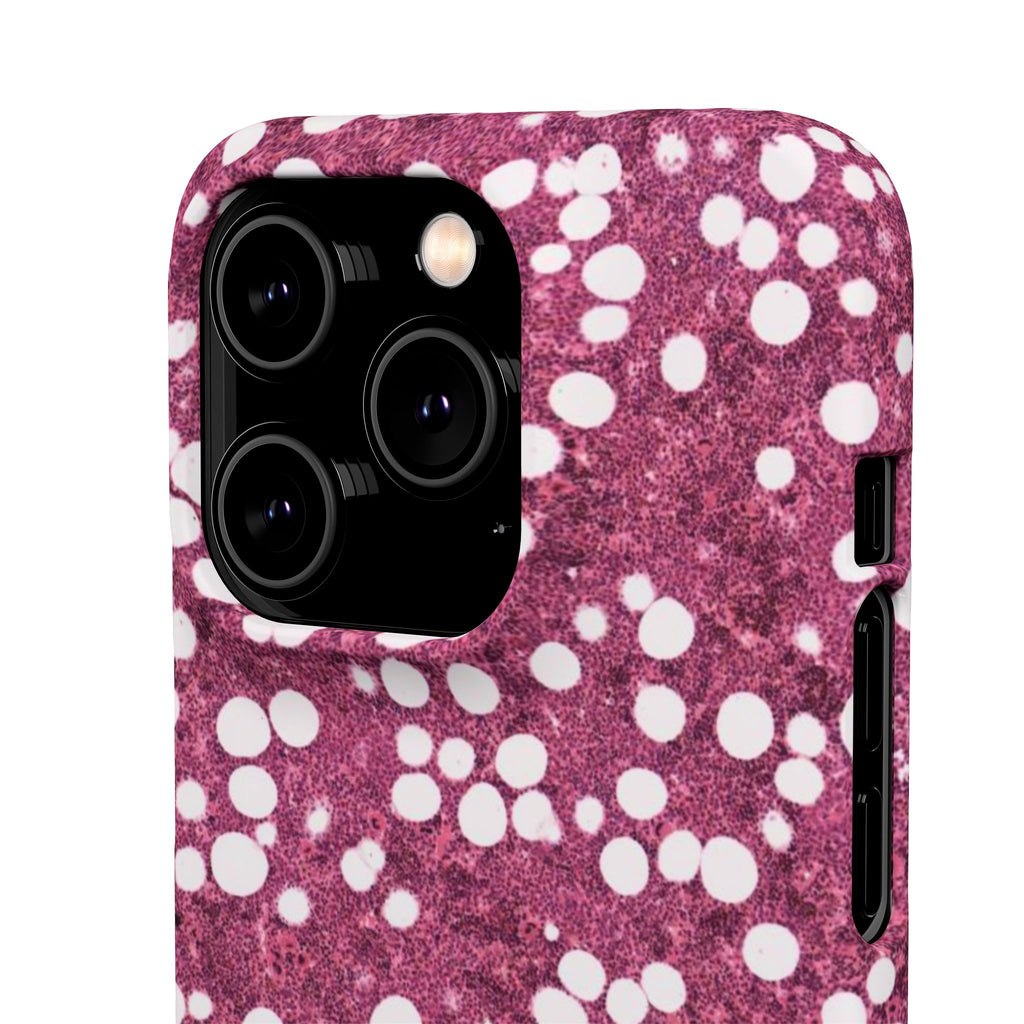 Slim Case Myelolipom