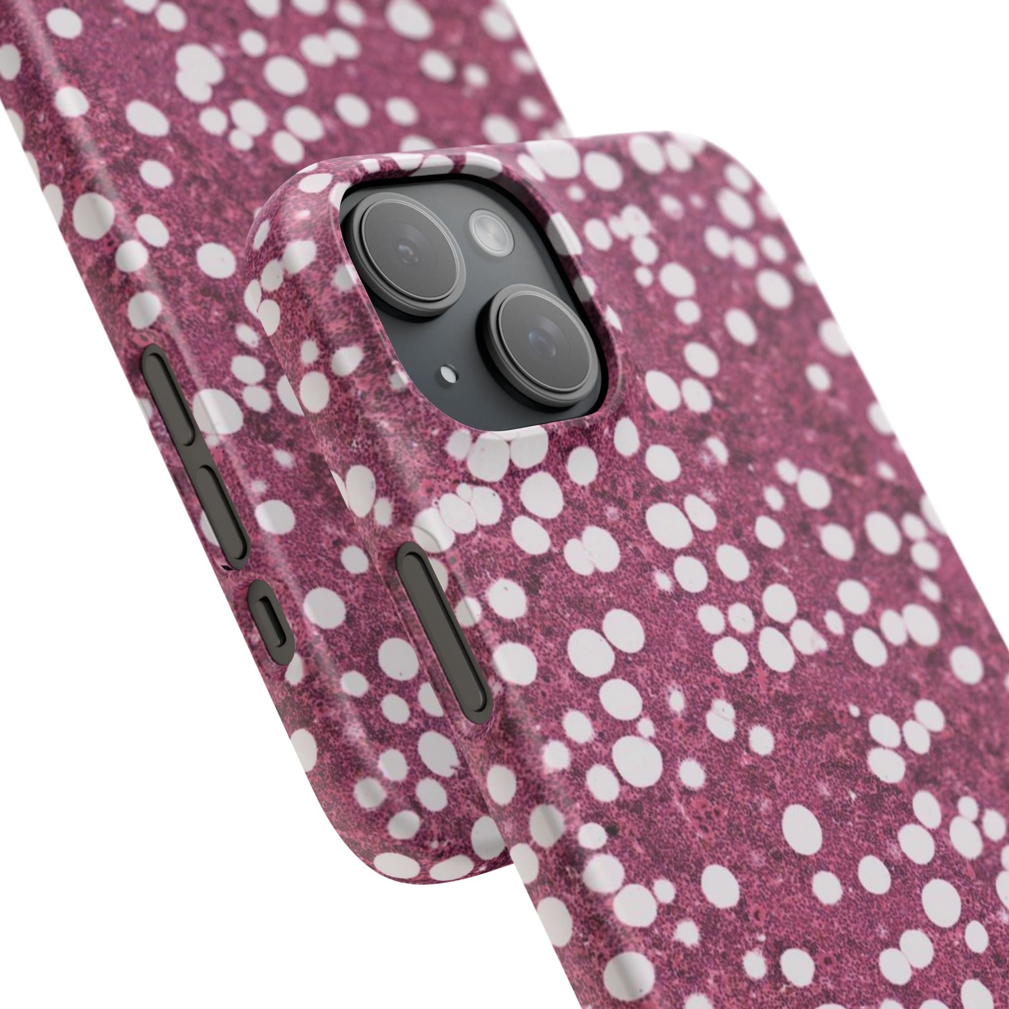 Slim Case Myelolipom