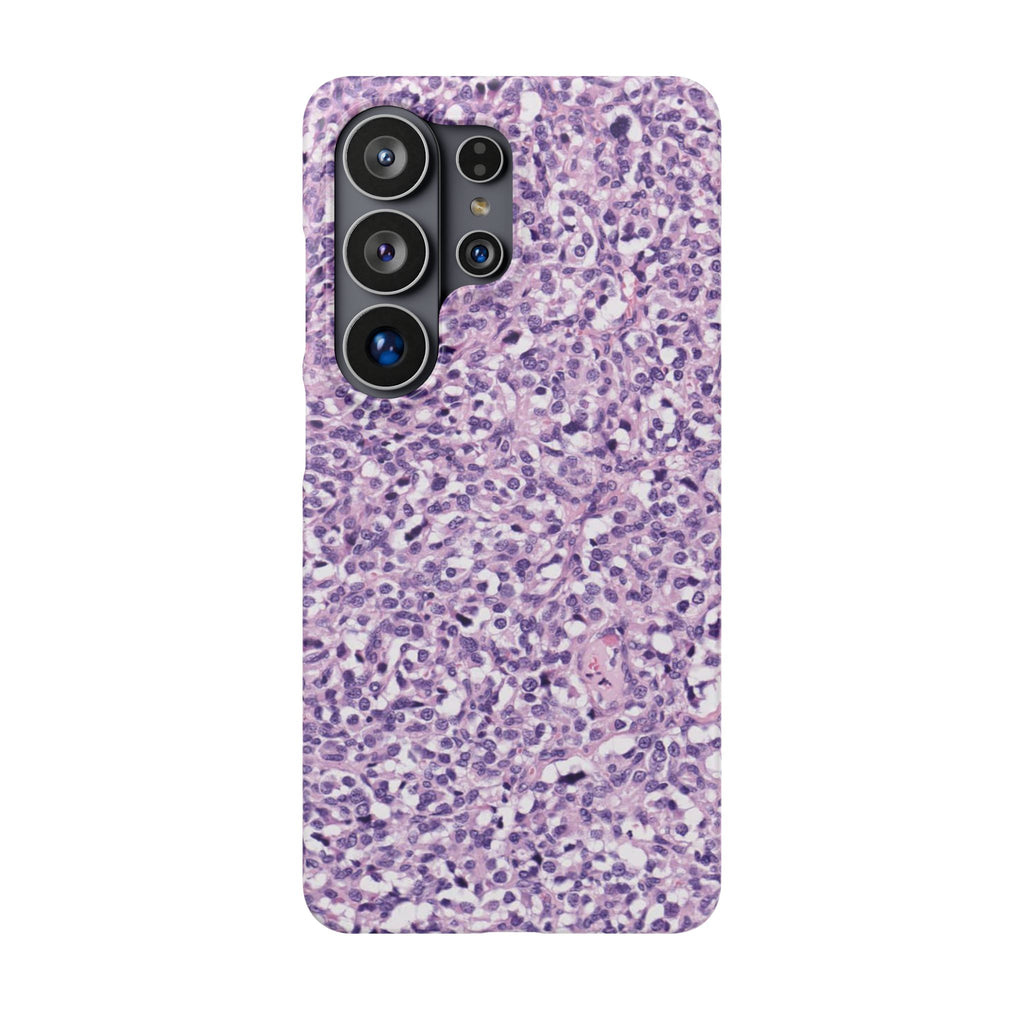 Slim Case Paraganglion