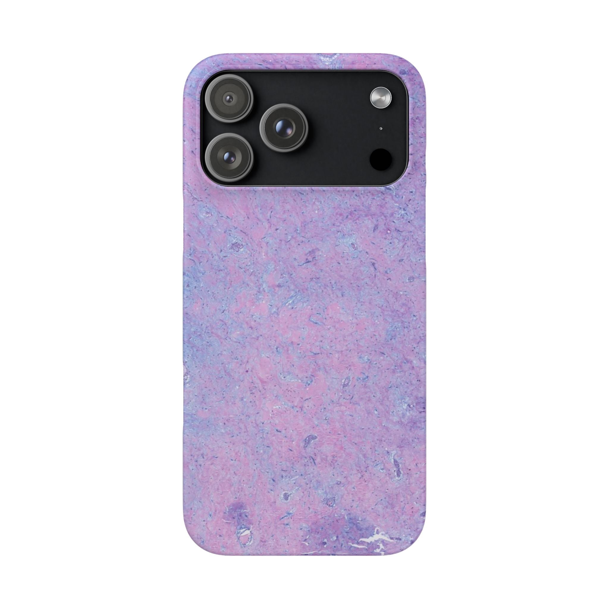 Slim Case Arterielles Myxom