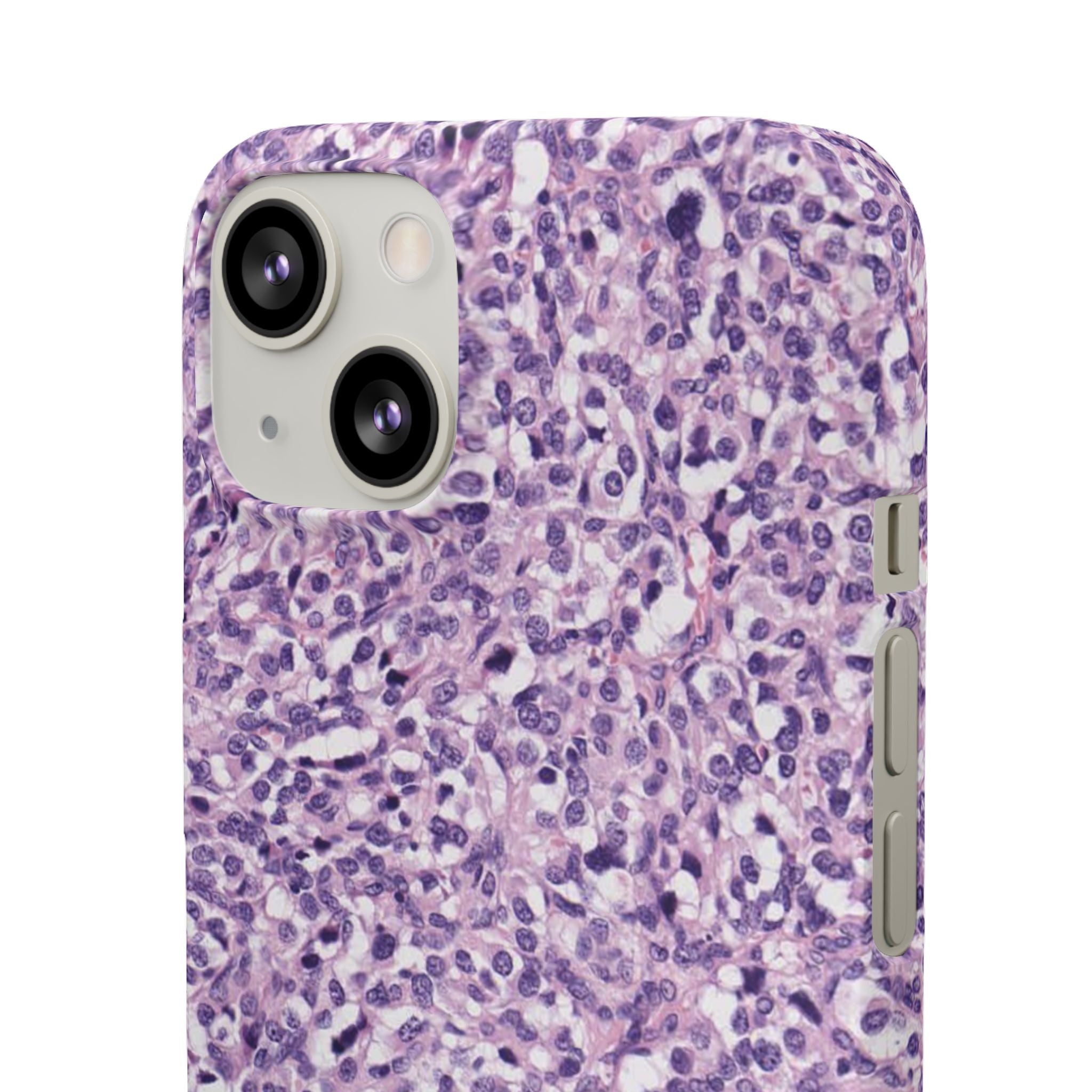 Slim Case Paraganglion