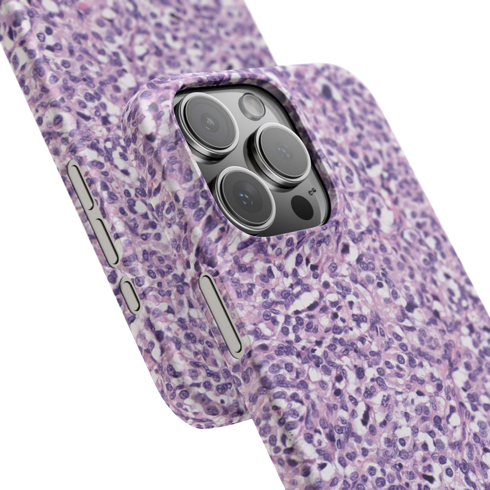 Slim Case Paraganglion