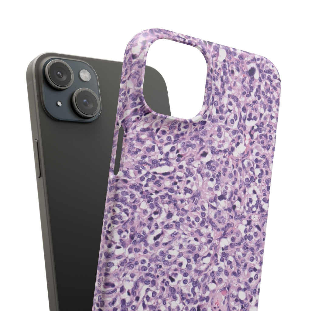 Slim Case Paraganglion