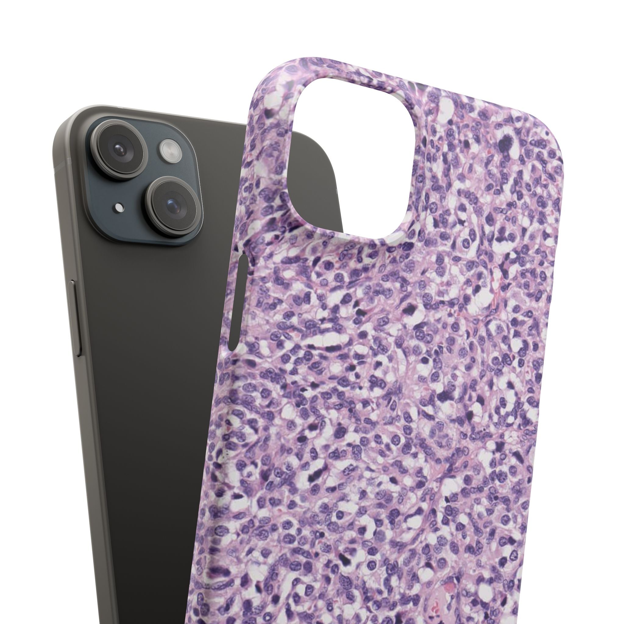 Slim Case Paraganglion