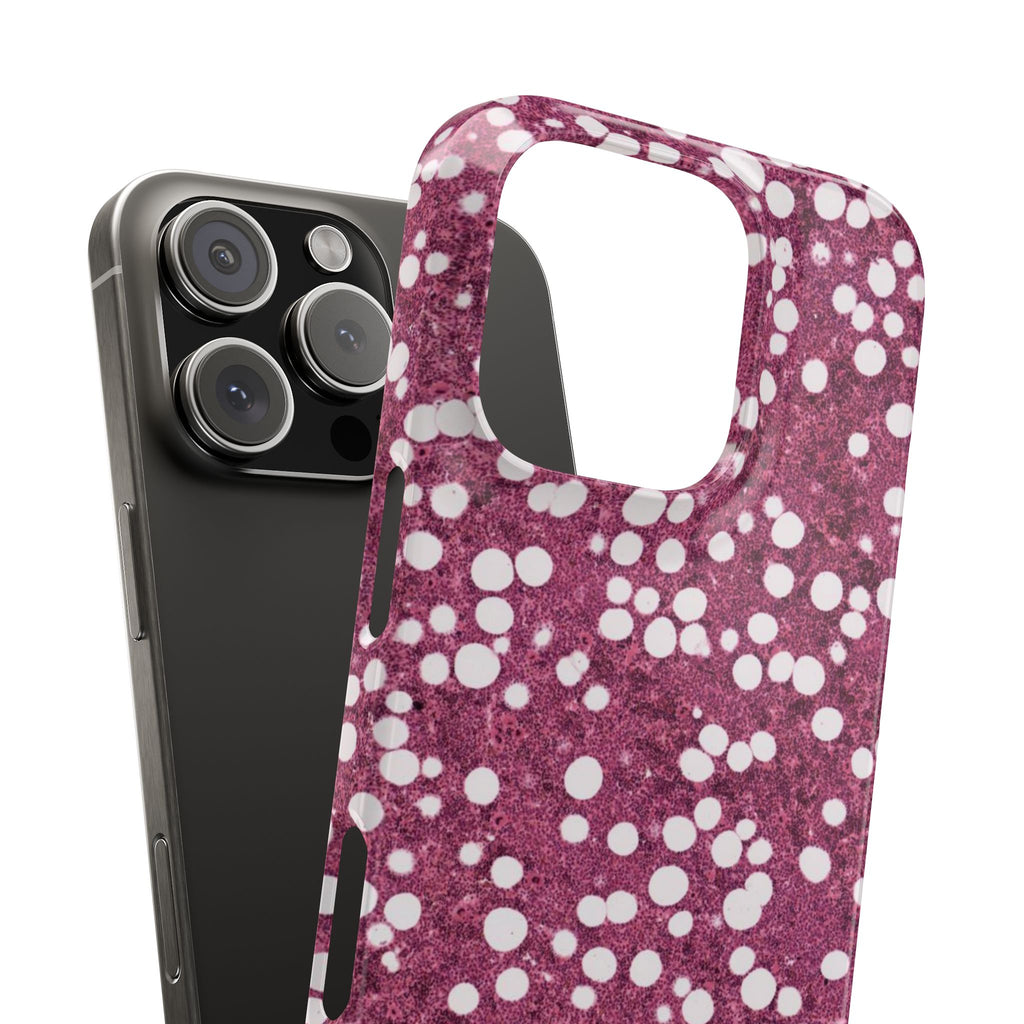 Slim Case Myelolipom