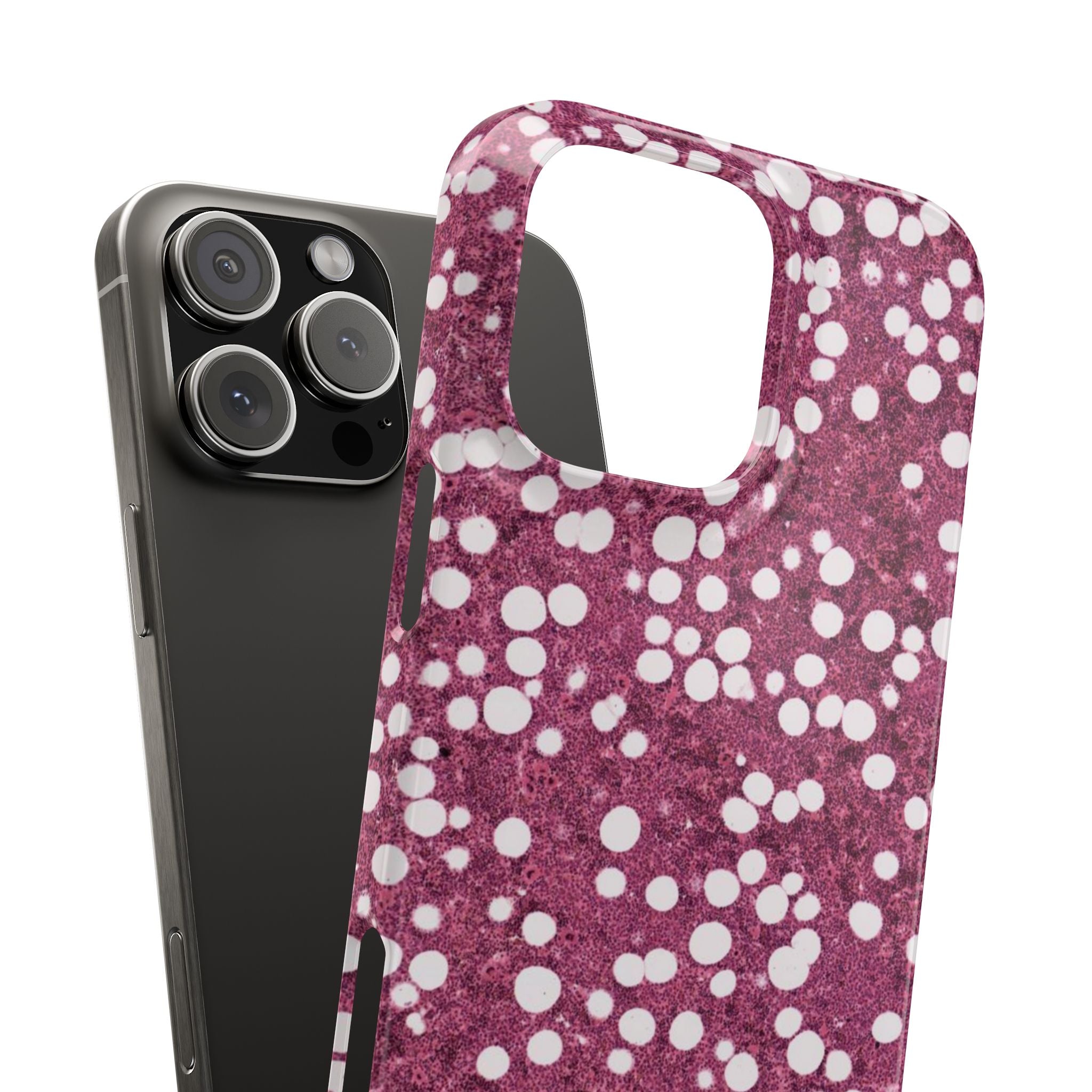 Slim Case Myelolipom