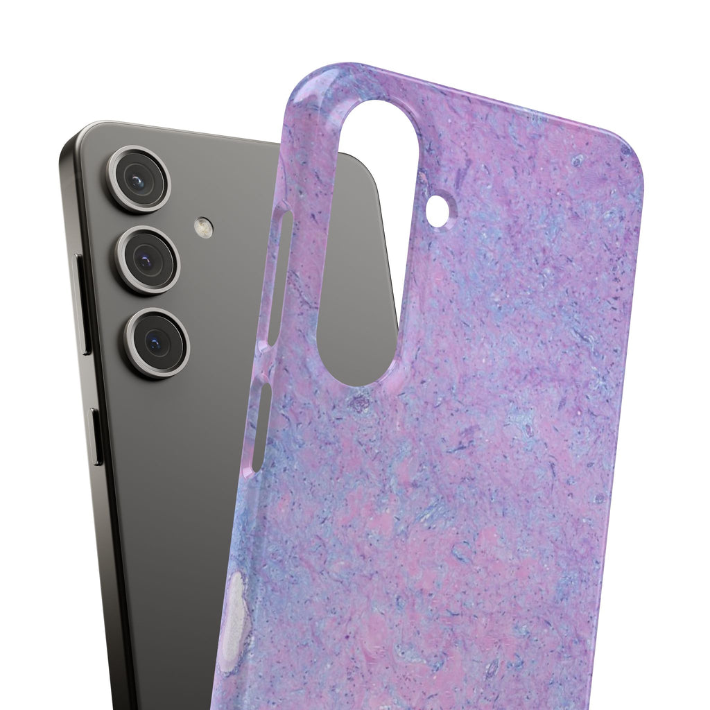 Slim Case Arterielles Myxom