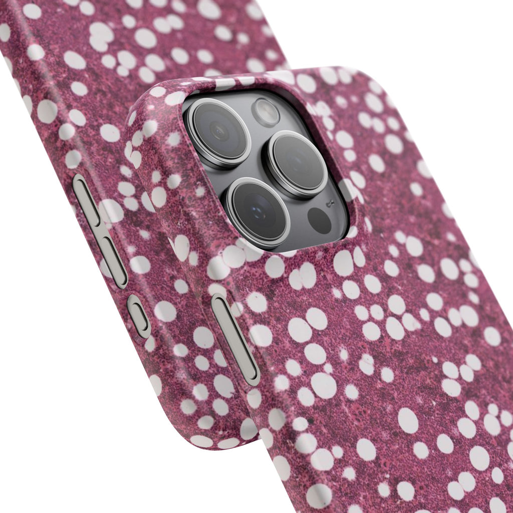 Slim Case Myelolipom