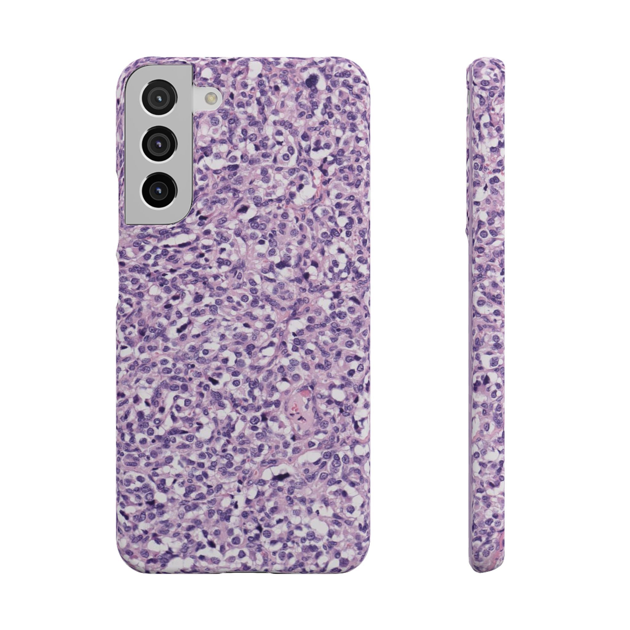 Slim Case Paraganglion