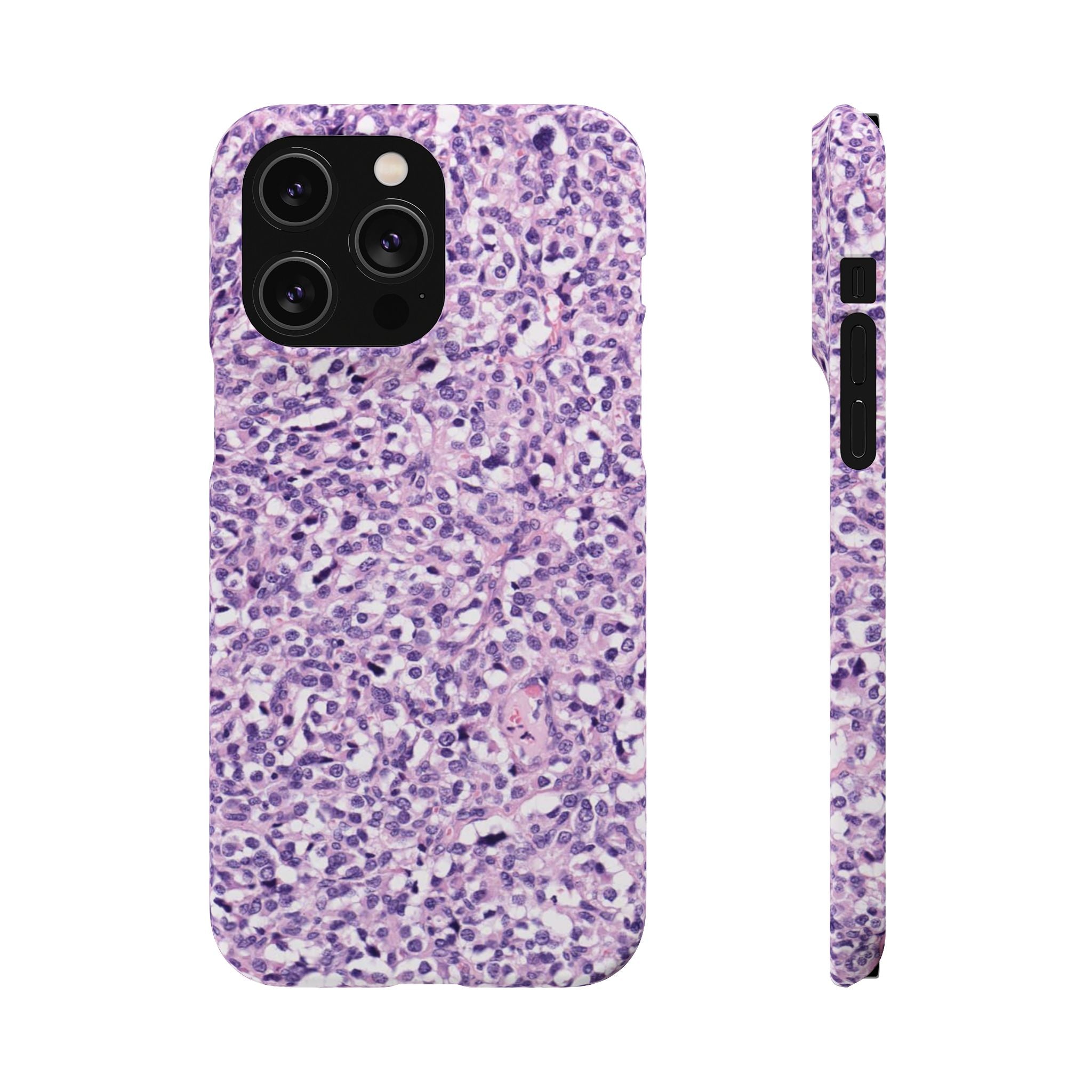 Slim Case Paraganglion
