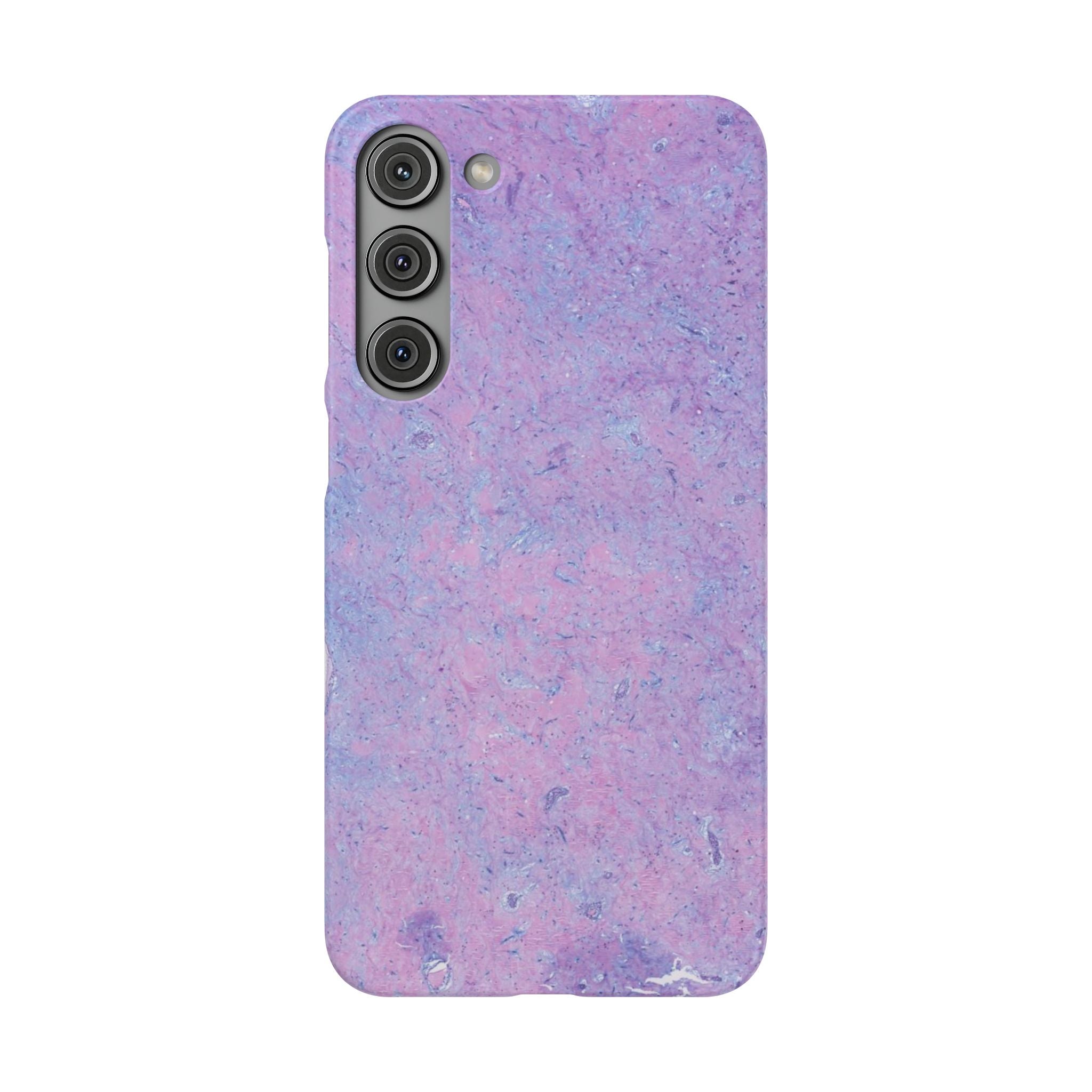 Slim Case Arterielles Myxom