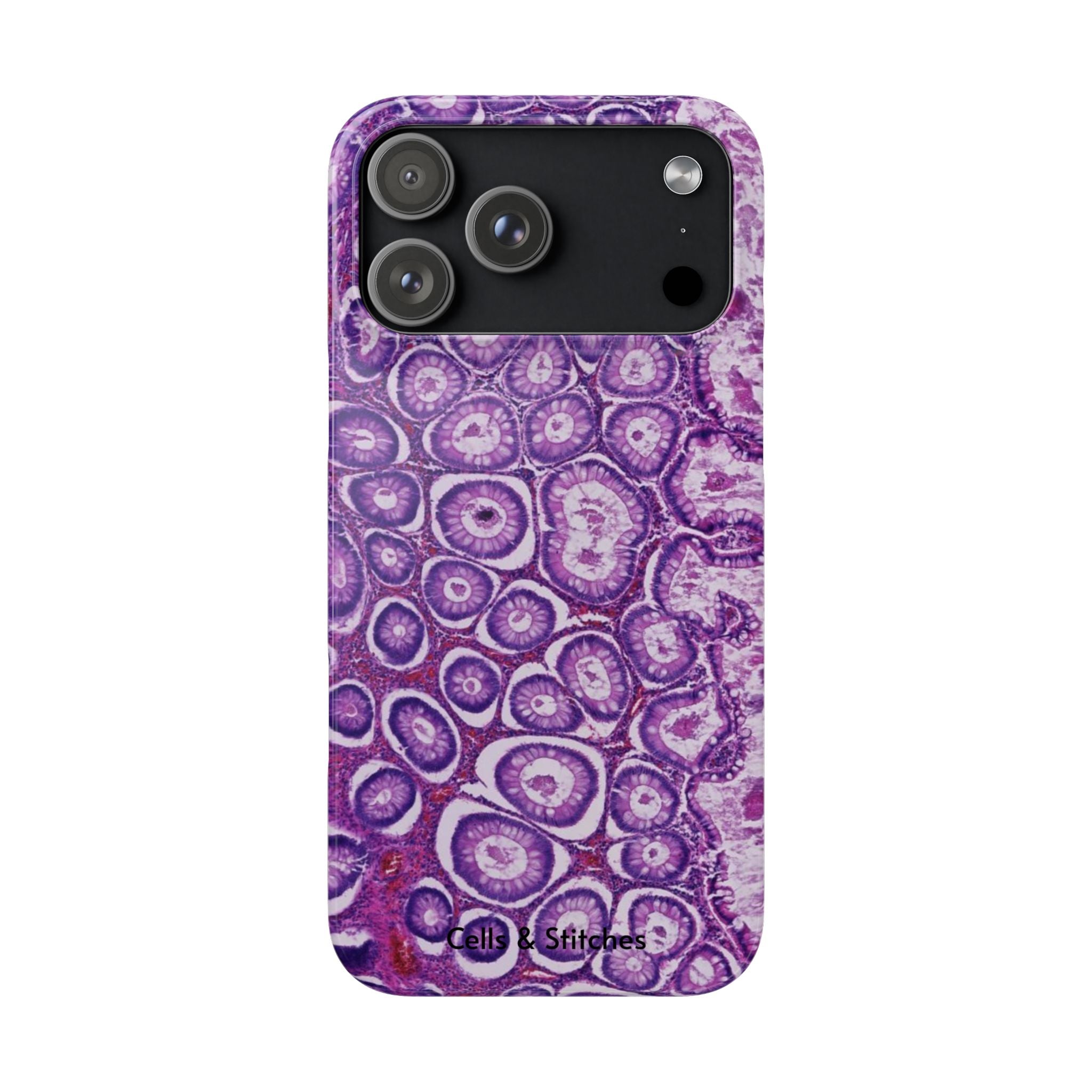 Slim Case Peutz-Jeghers Polyp