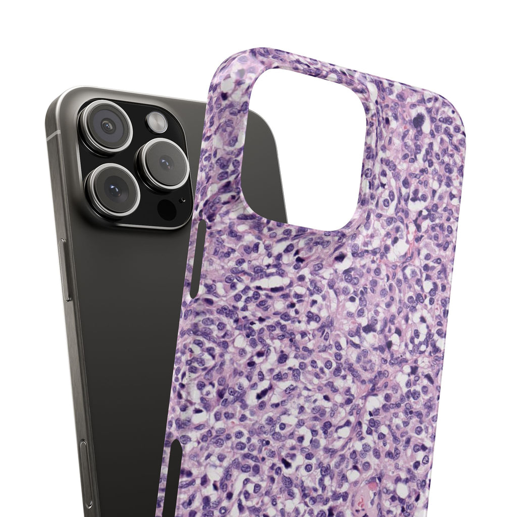 Slim Case Paraganglion