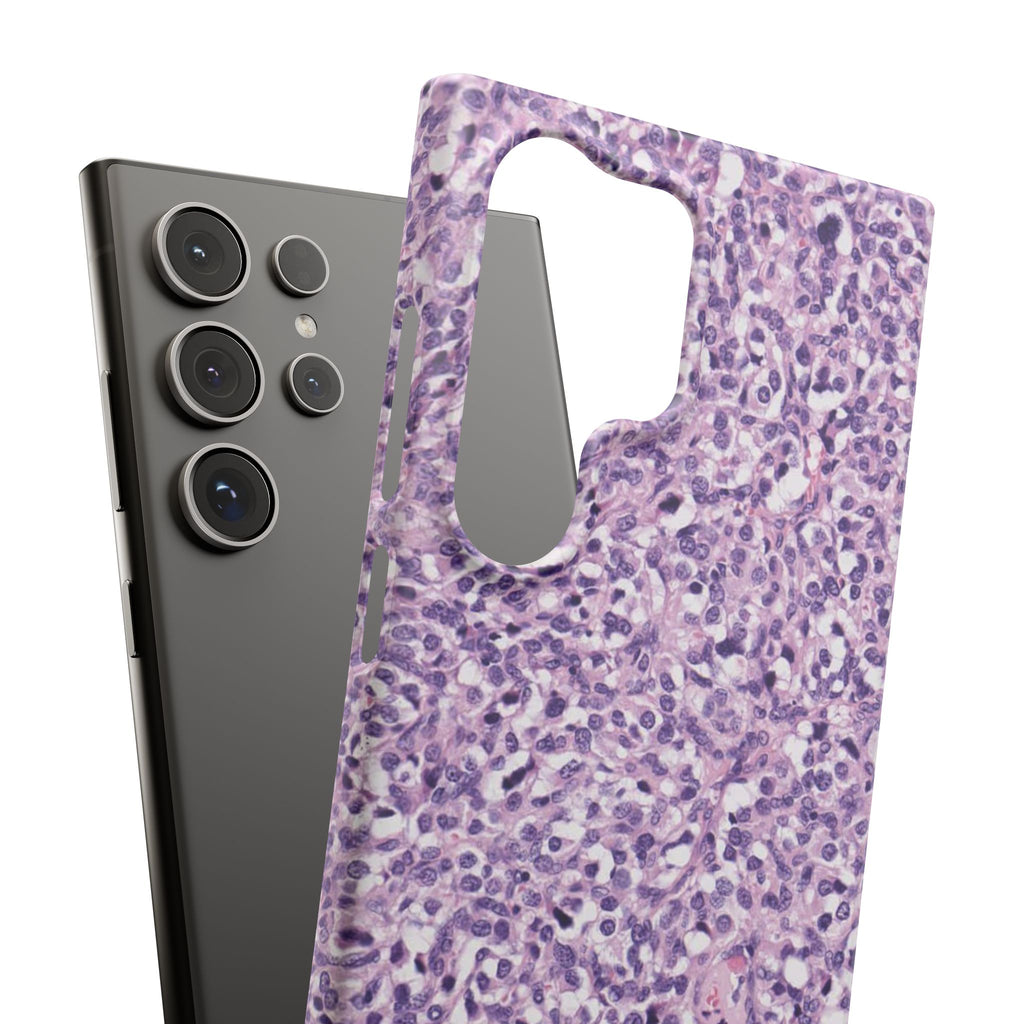 Slim Case Paraganglion