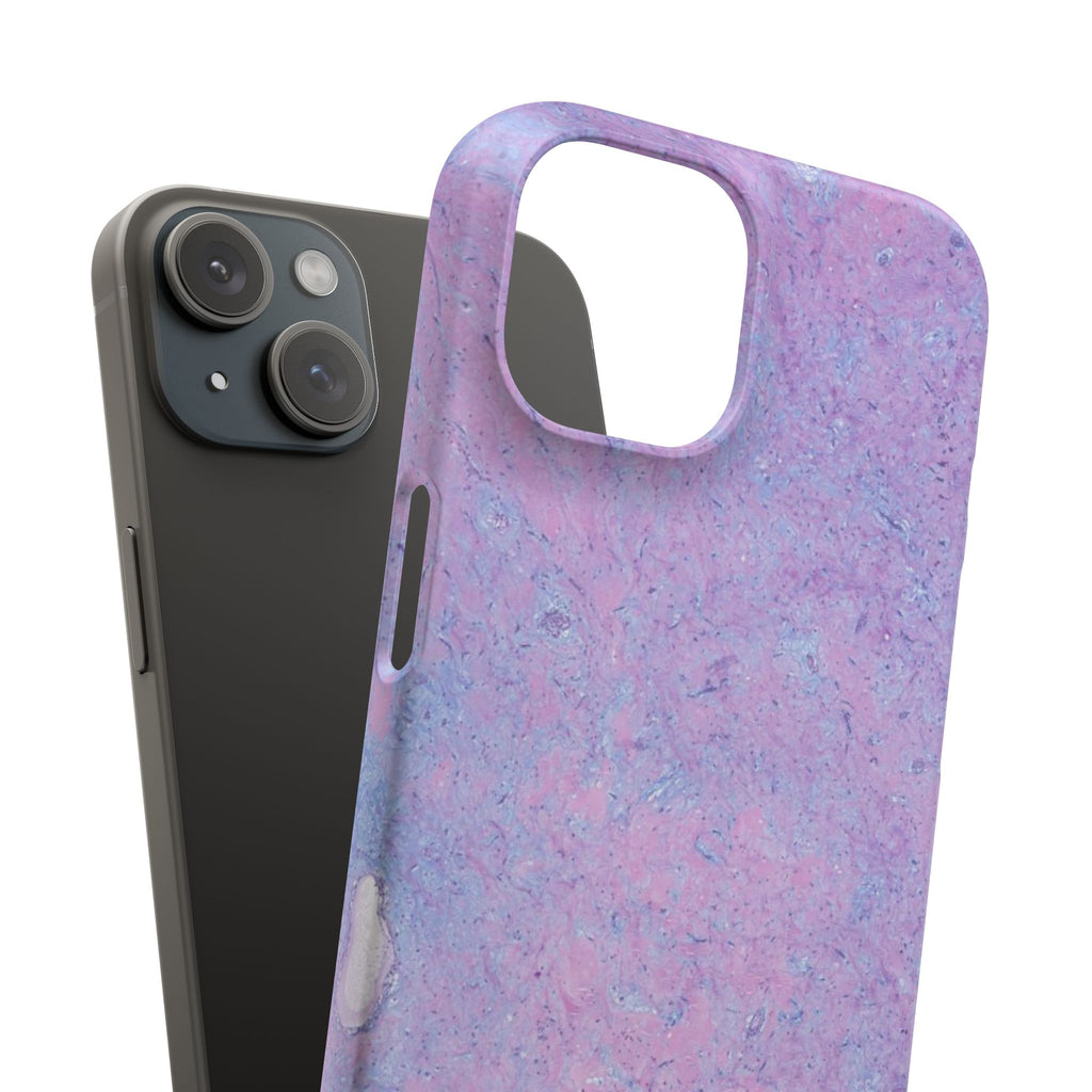 Slim Case Arterielles Myxom