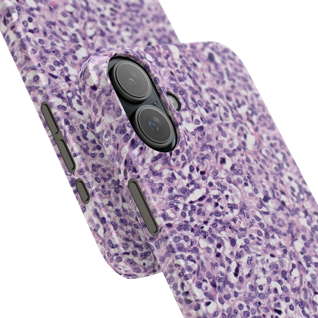 Slim Case Paraganglion