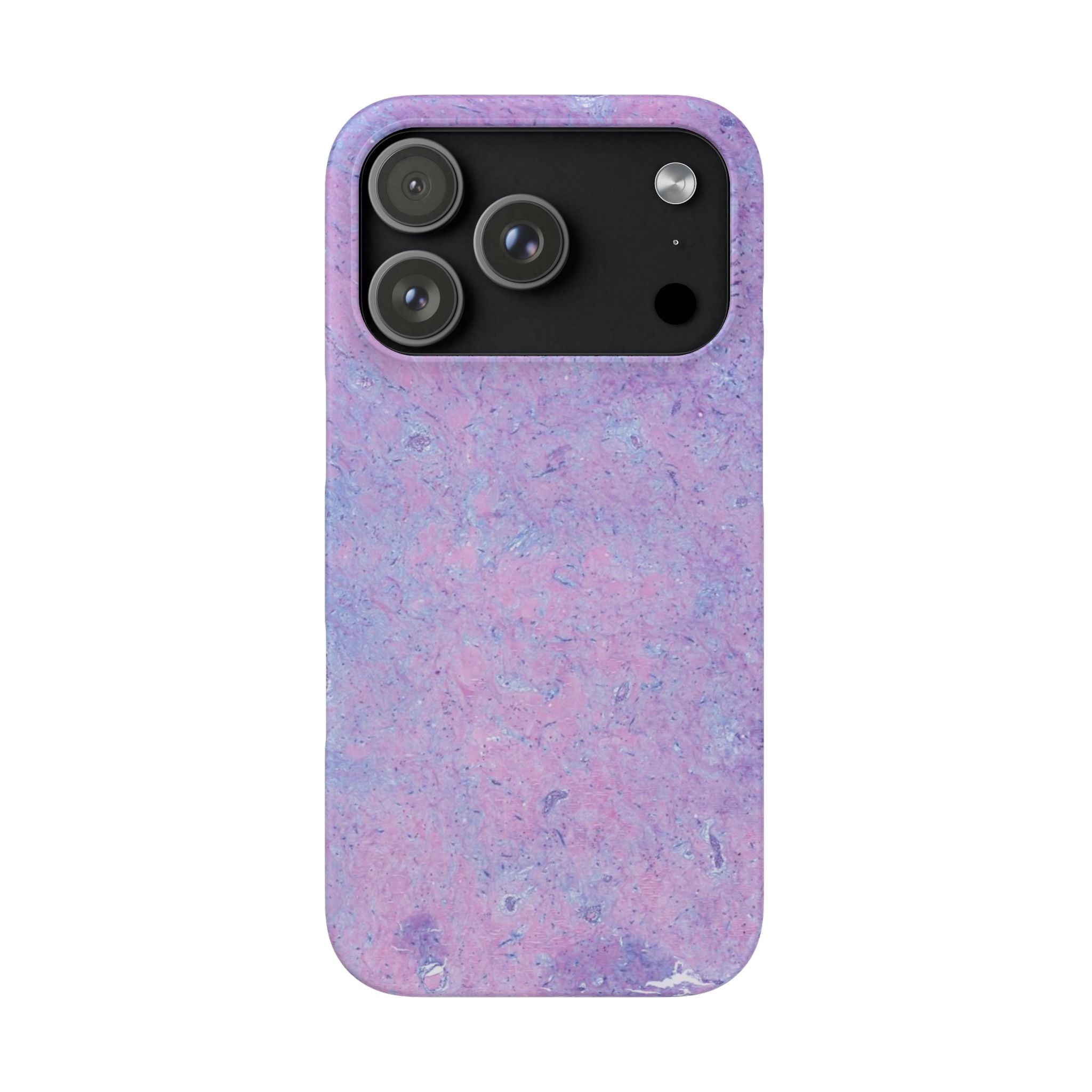 Slim Case Arterielles Myxom