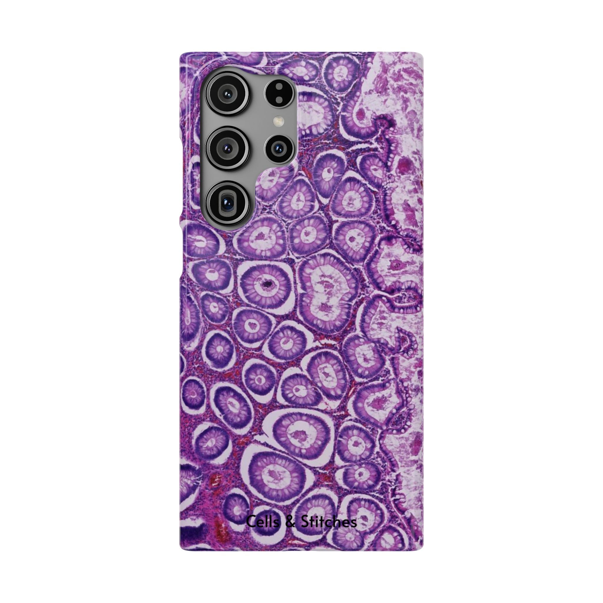 Slim Case Peutz-Jeghers Polyp