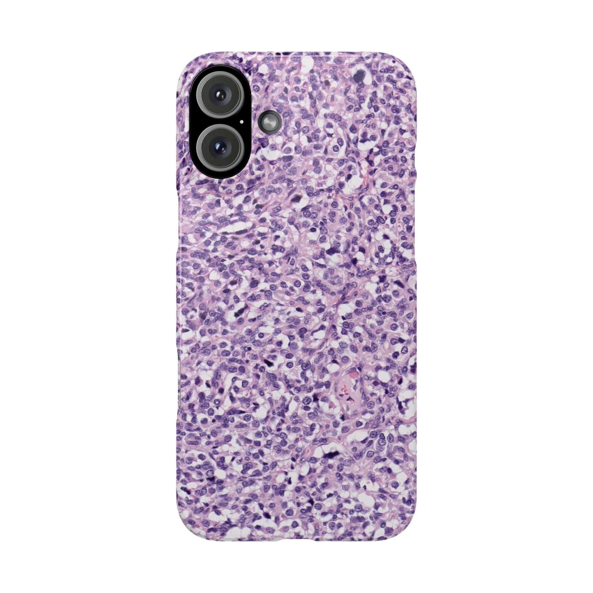 Slim Case Paraganglion