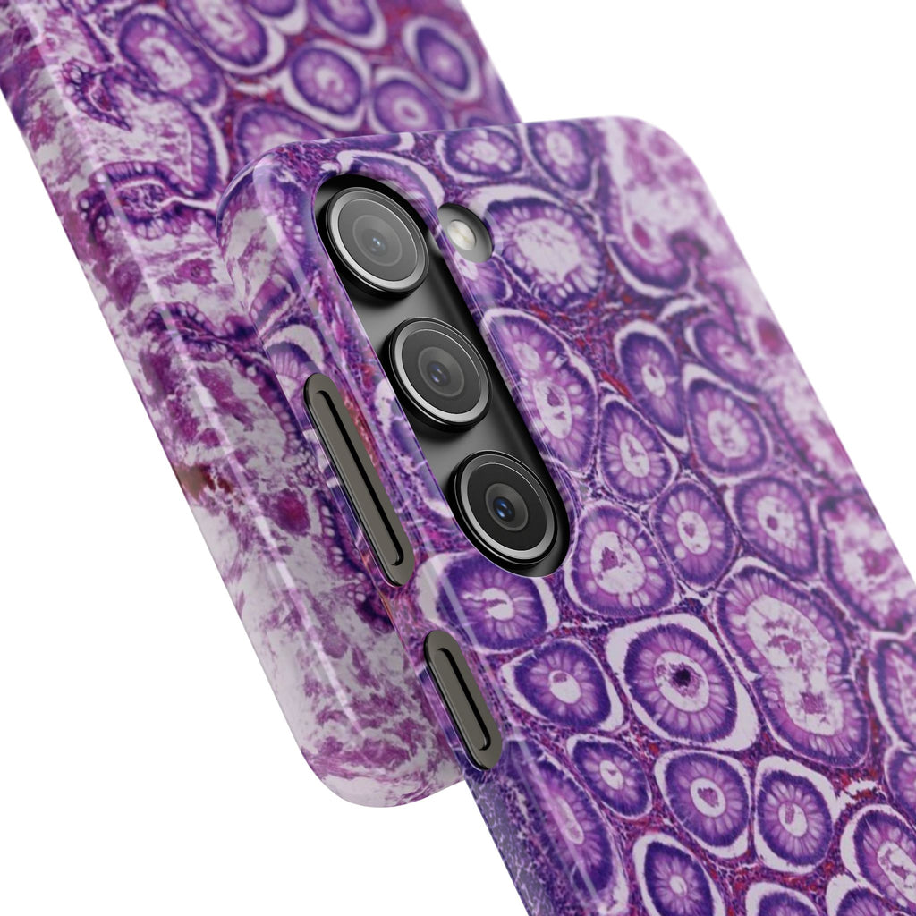 Slim Case Peutz-Jeghers Polyp