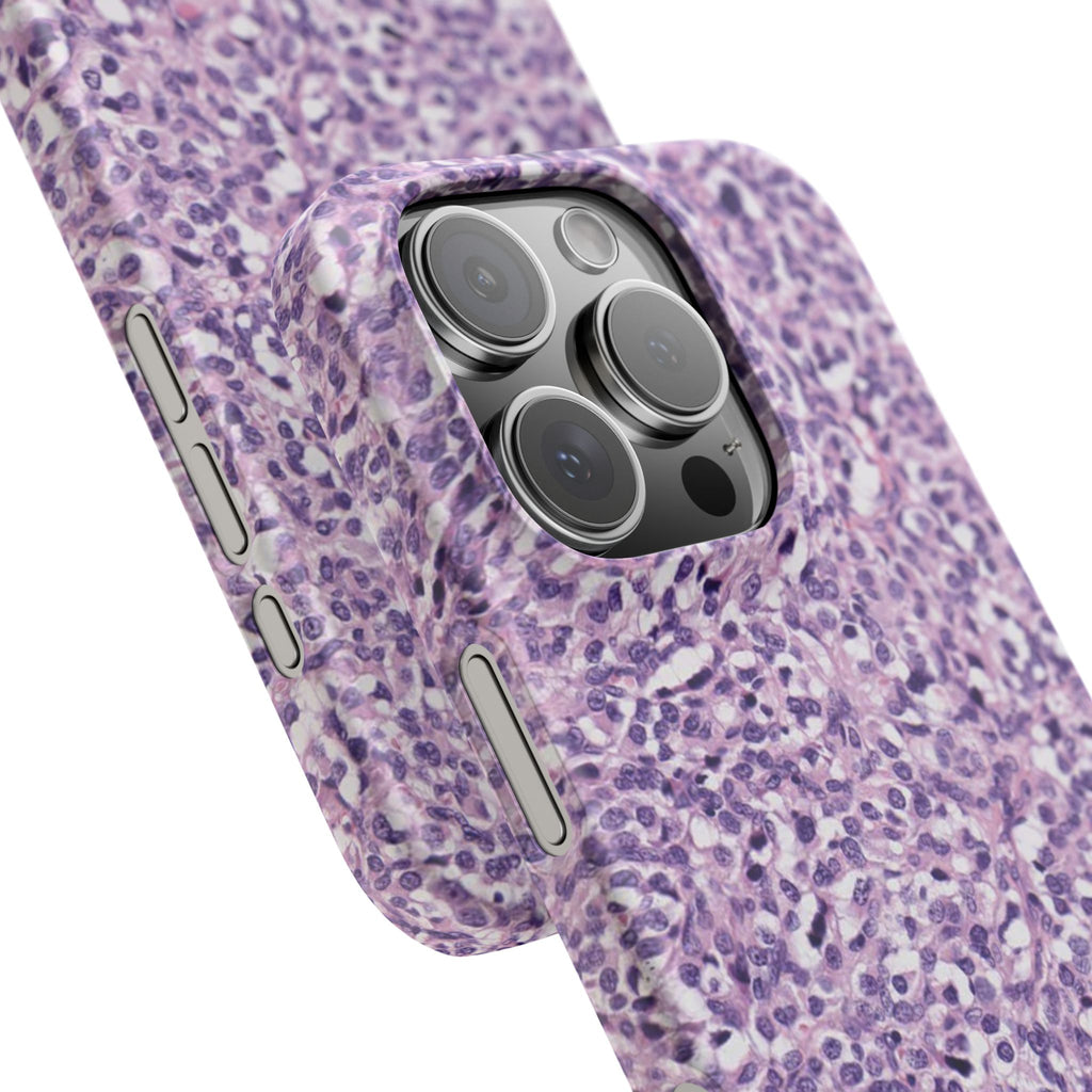 Slim Case Paraganglion