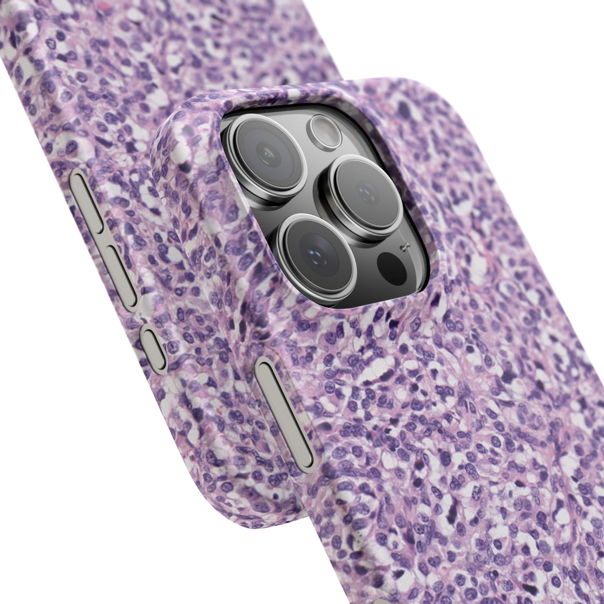 Slim Case Paraganglion