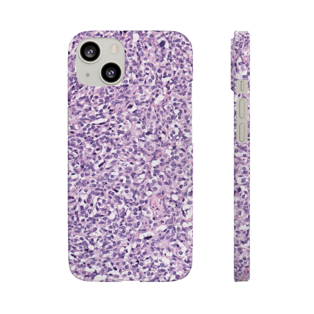 Slim Case Paraganglion