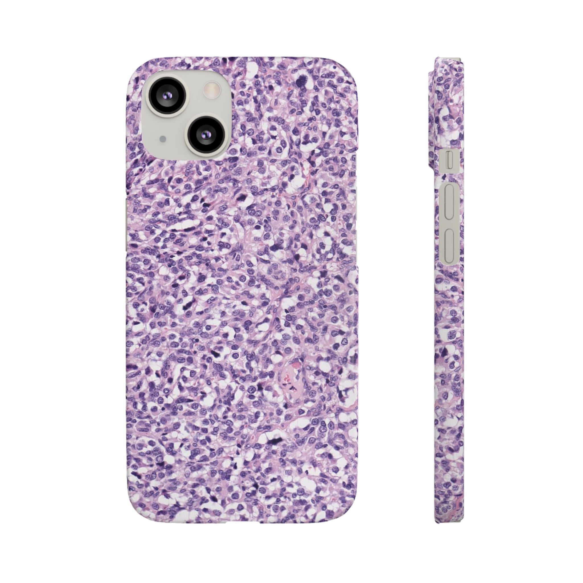 Slim Case Paraganglion