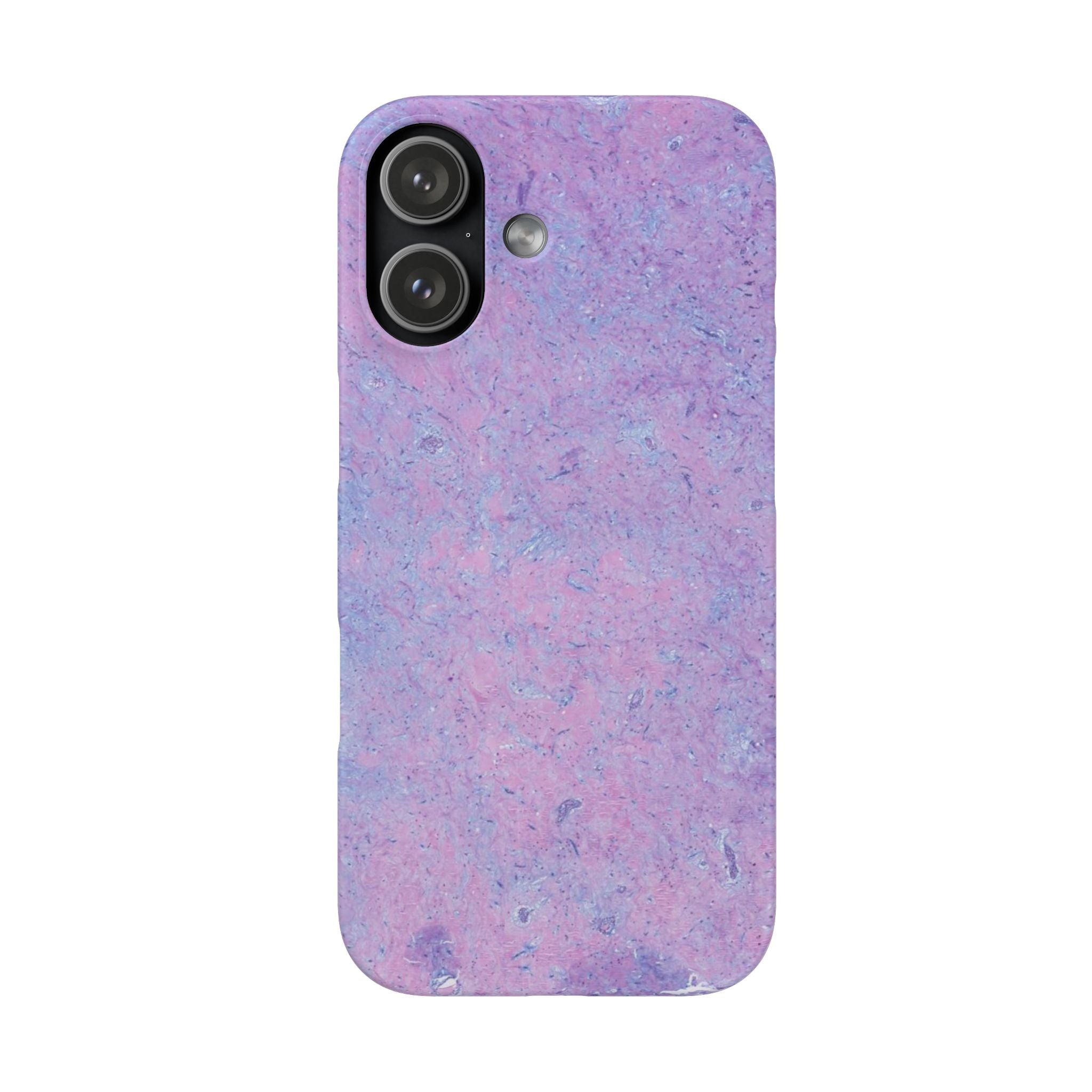 Slim Case Arterielles Myxom
