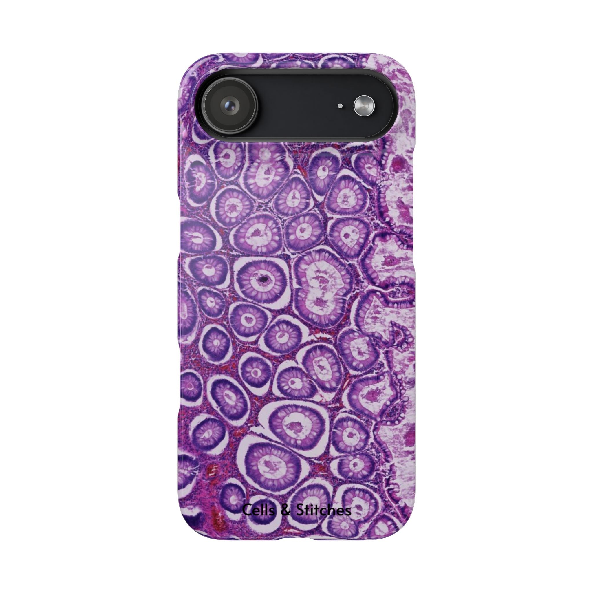 Slim Case Peutz-Jeghers Polyp