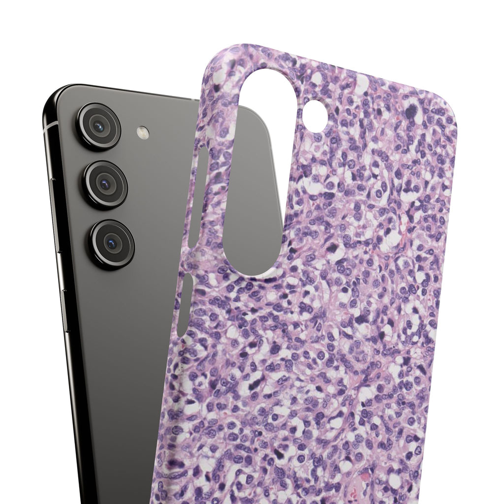 Slim Case Paraganglion