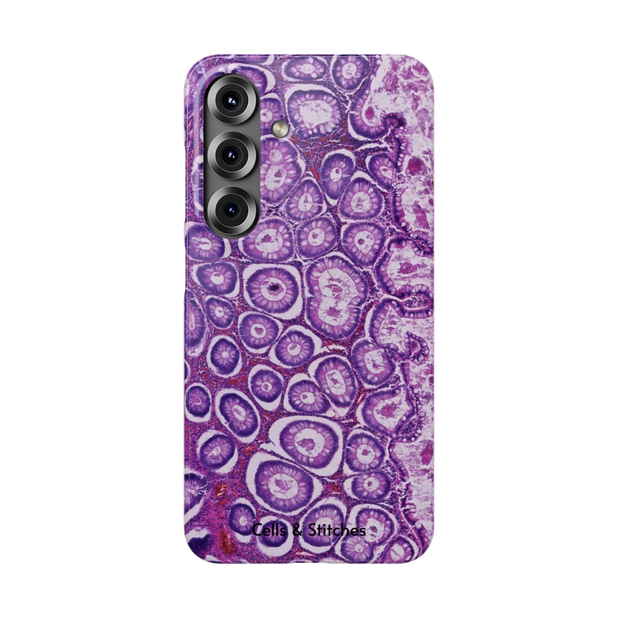 Slim Case Peutz-Jeghers Polyp