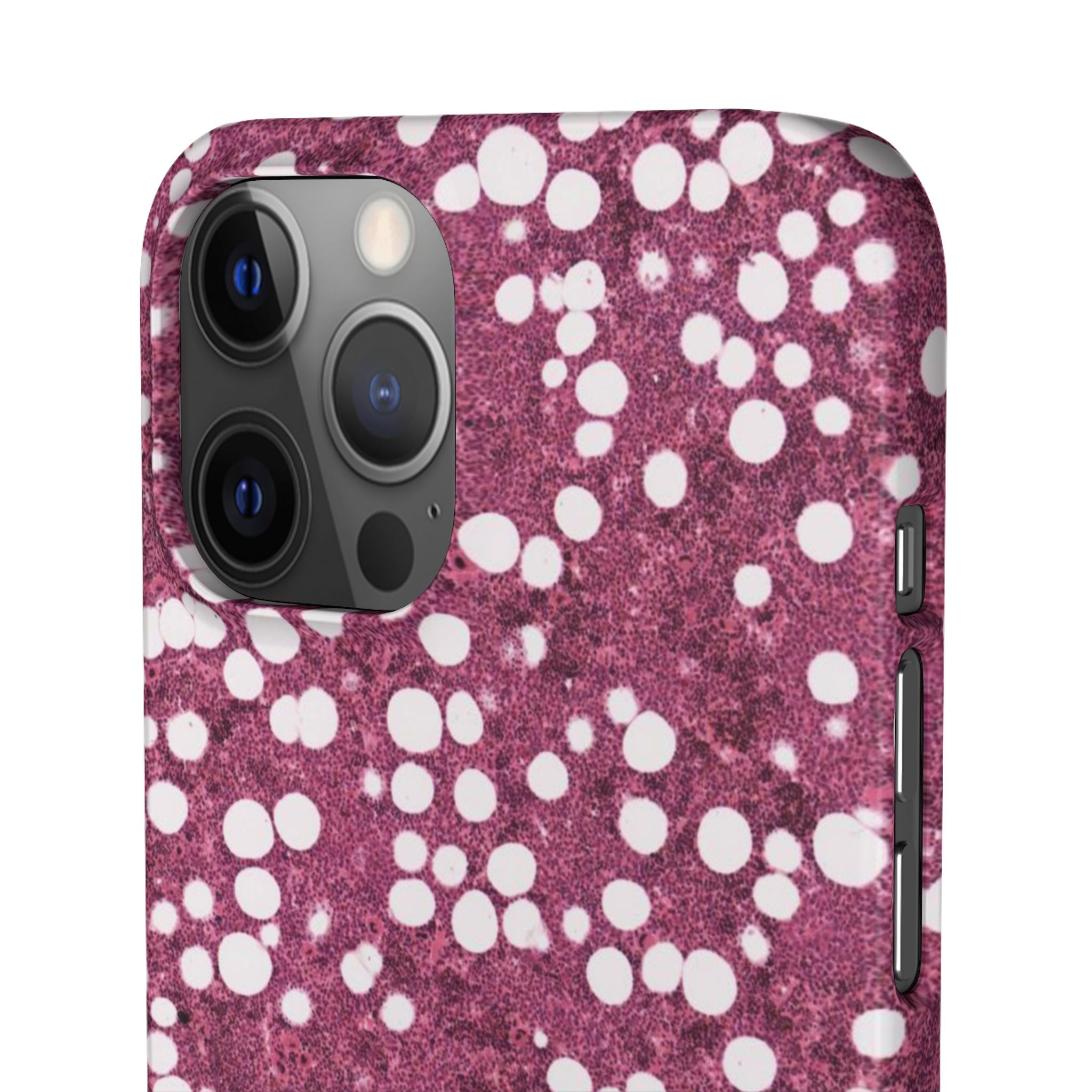 Slim Case Myelolipom