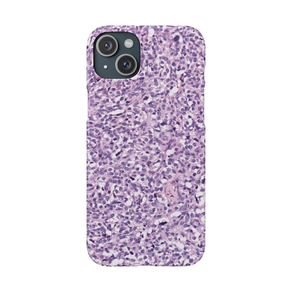 Slim Case Paraganglion