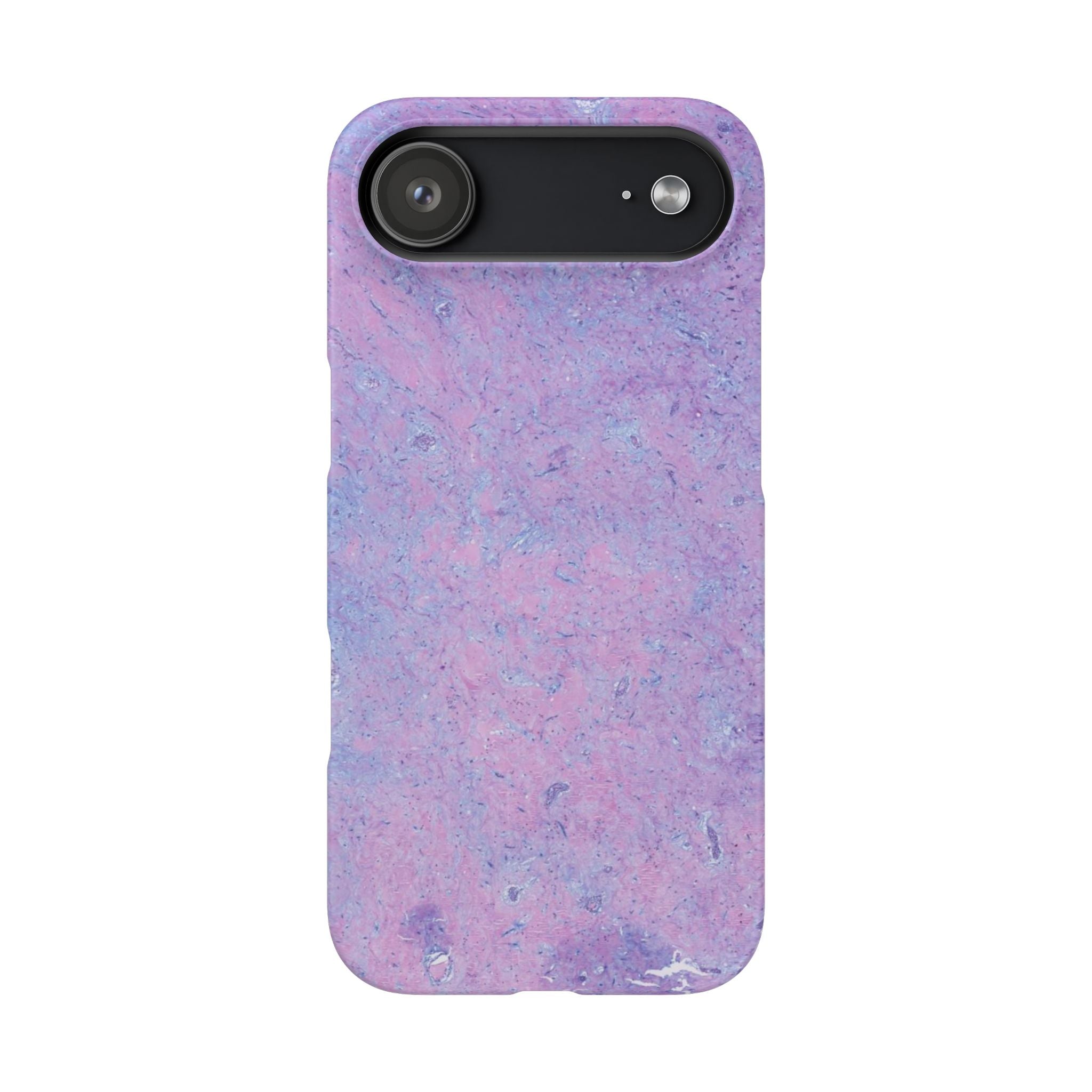 Slim Case Arterielles Myxom