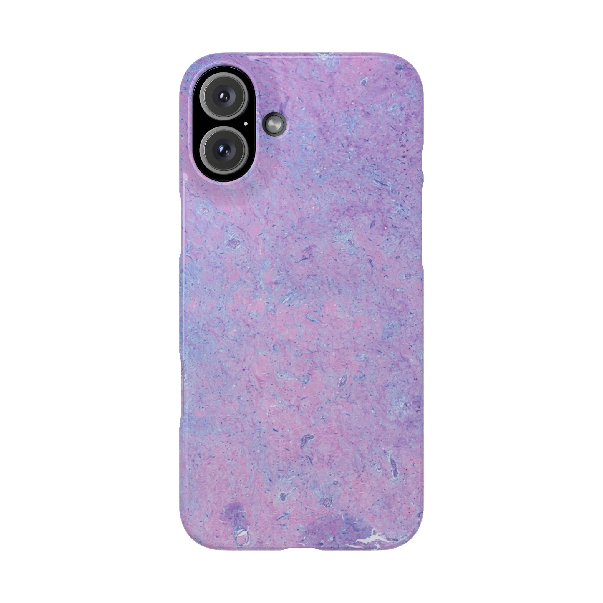 Slim Case Arterielles Myxom