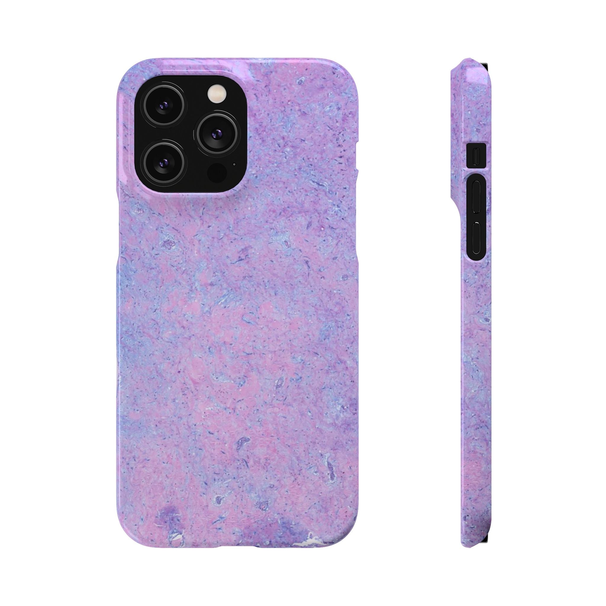 Slim Case Arterielles Myxom