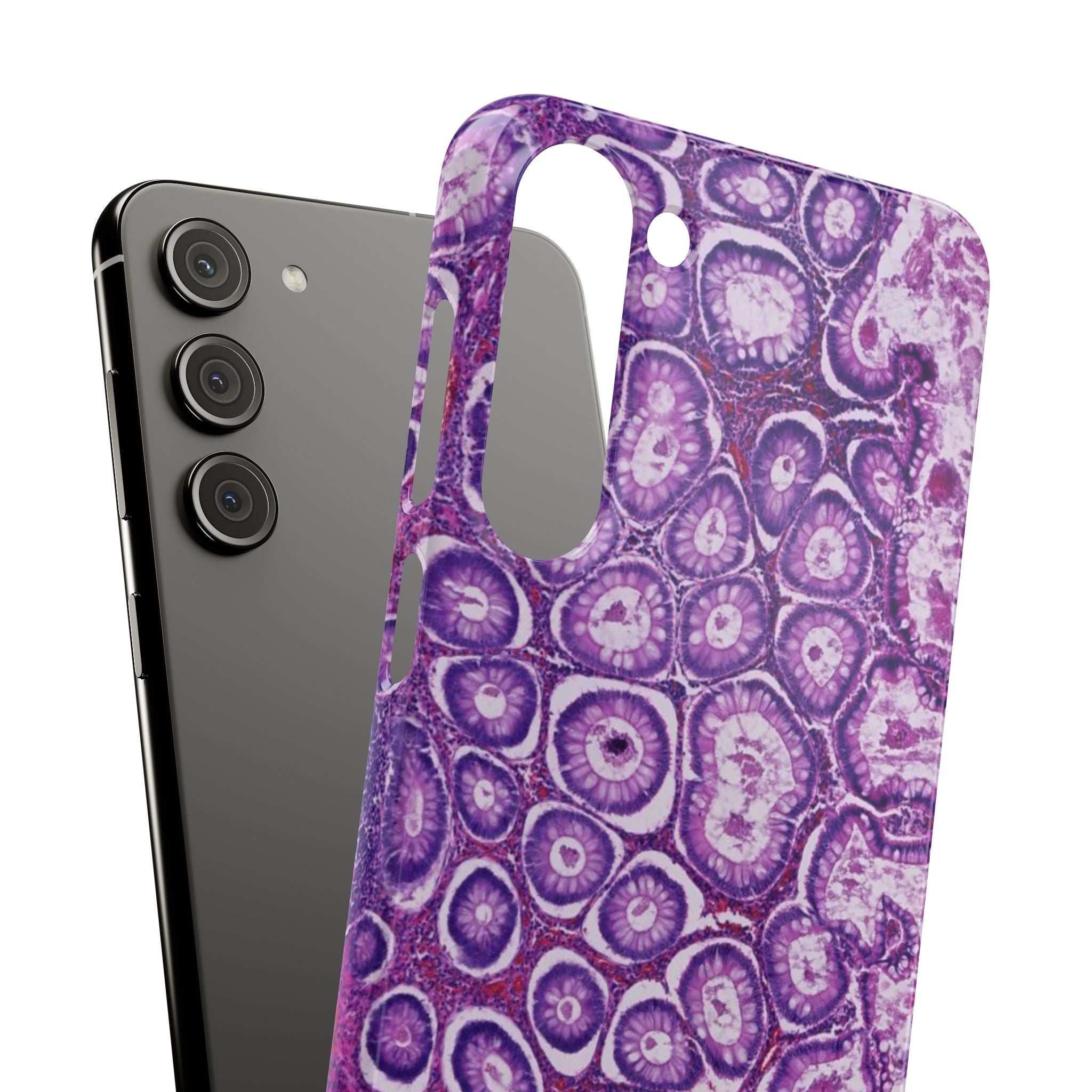 Slim Case Peutz-Jeghers Polyp