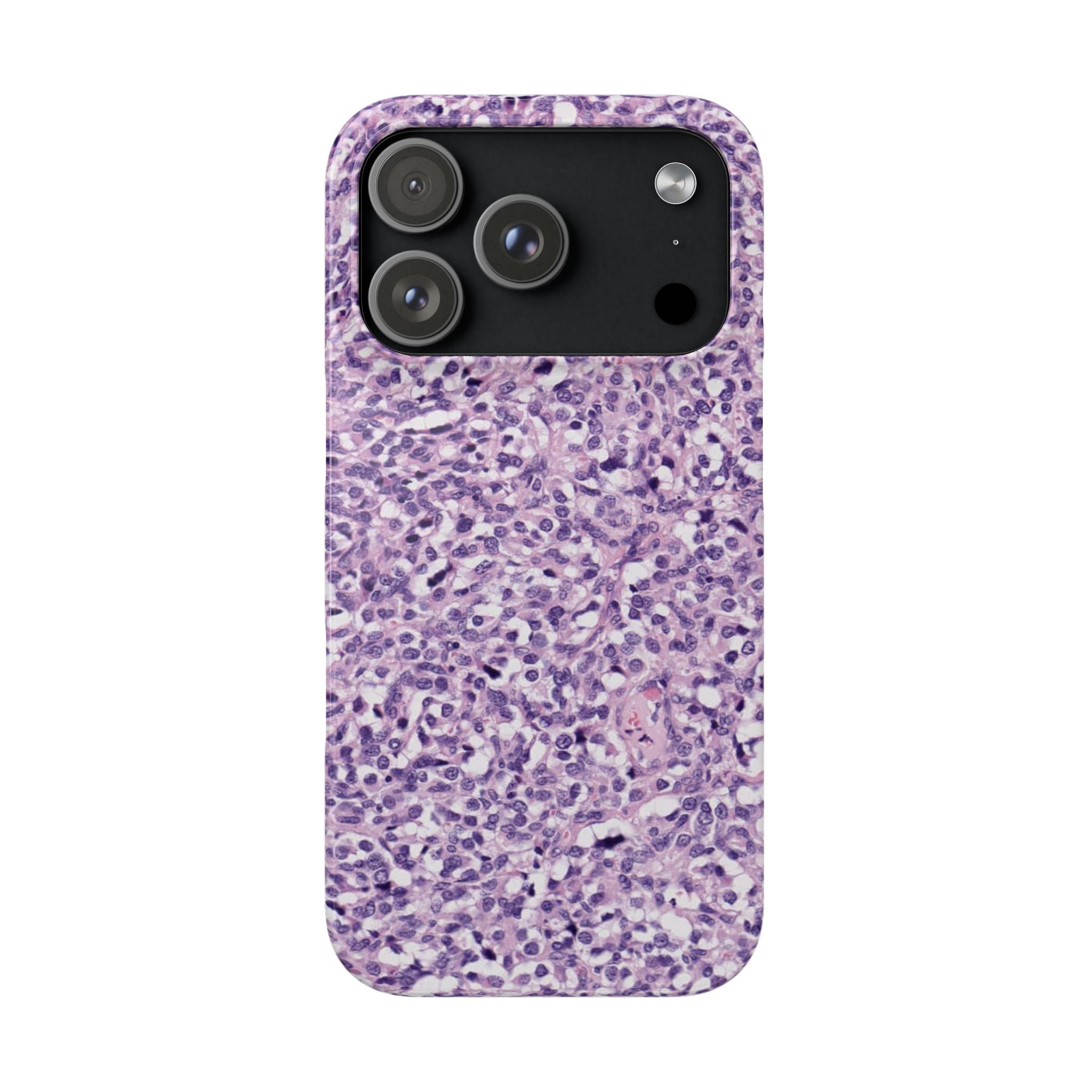Slim Case Paraganglion