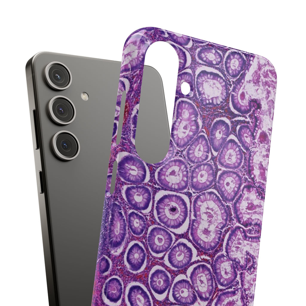 Slim Case Peutz-Jeghers Polyp