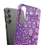 Slim Case Peutz-Jeghers Polyp