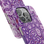 Slim Case Peutz-Jeghers Polyp