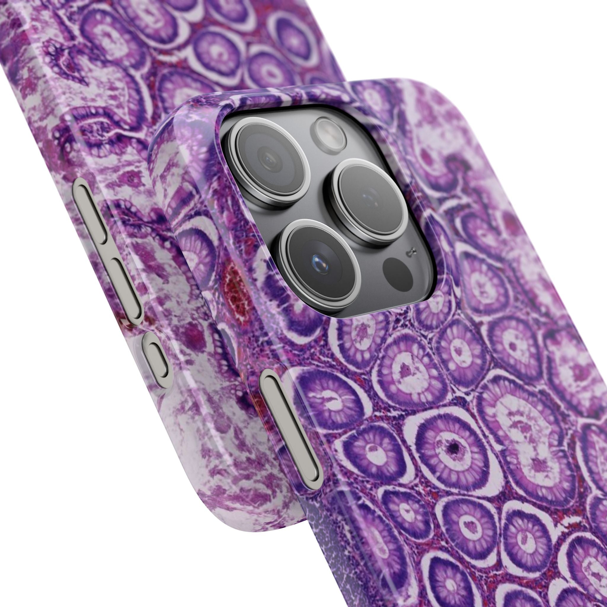 Slim Case Peutz-Jeghers Polyp